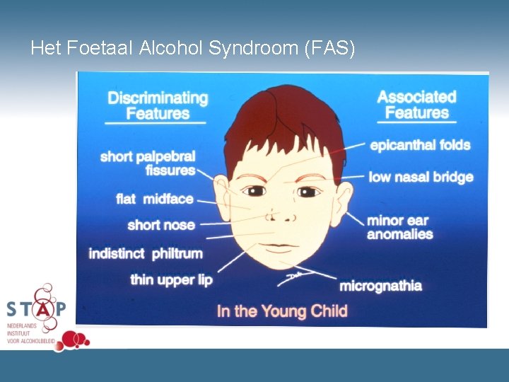 Het Foetaal Alcohol Syndroom (FAS) 