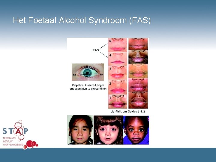 Het Foetaal Alcohol Syndroom (FAS) 