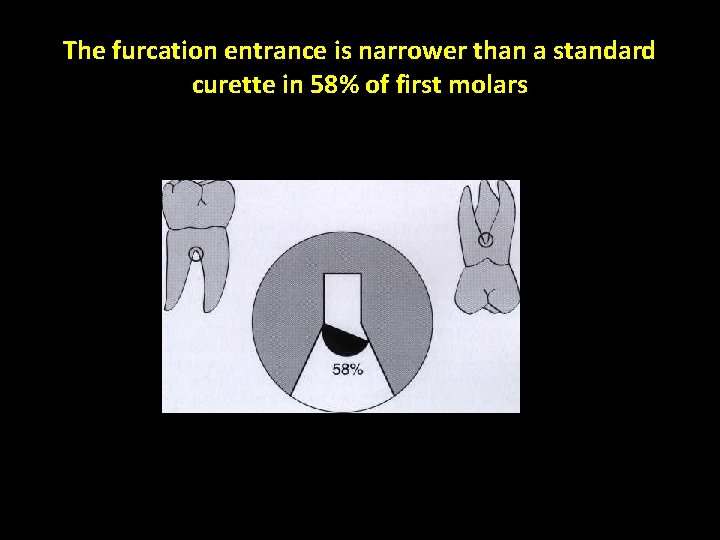 The furcation entrance is narrower than a standard curette in 58% of first molars
