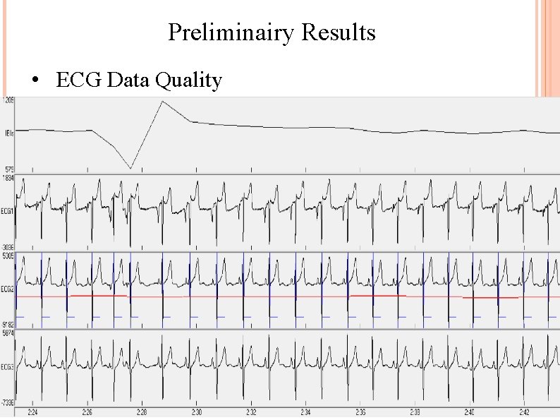 Preliminairy Results • ECG Data Quality 
