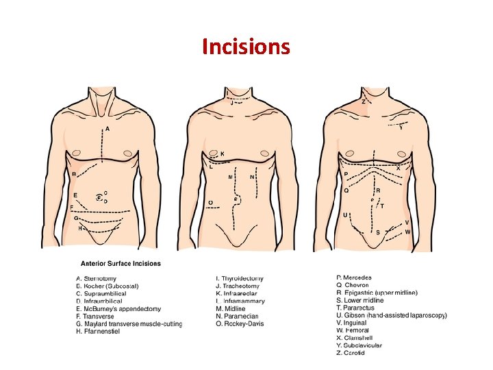 Incisions 