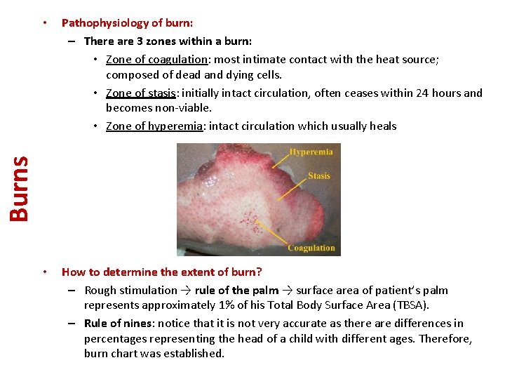 Pathophysiology of burn: – There are 3 zones within a burn: • Zone of