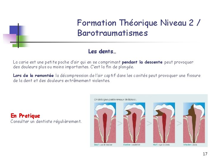 Formation Théorique Niveau 2 / Barotraumatismes Les dents… La carie est une petite poche