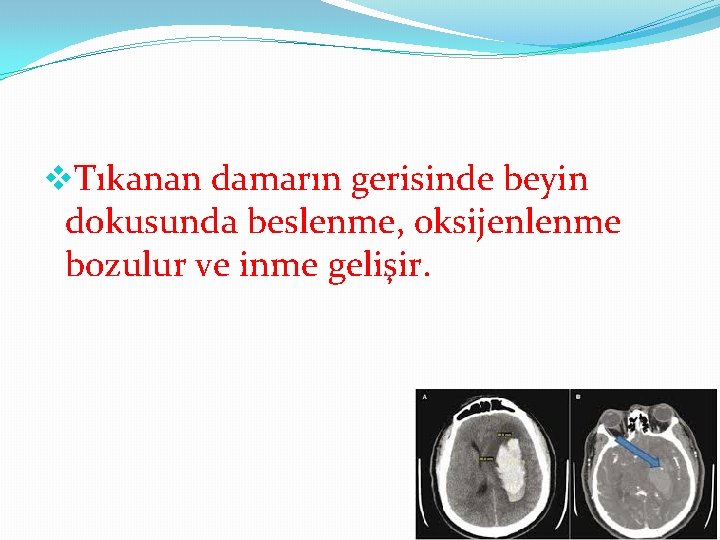 v. Tıkanan damarın gerisinde beyin dokusunda beslenme, oksijenlenme bozulur ve inme gelişir. 