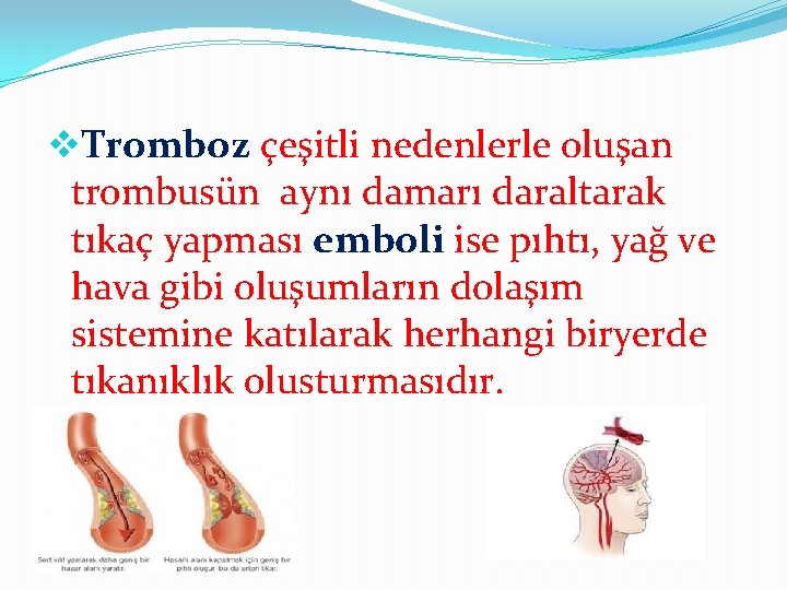 v. Tromboz çeşitli nedenlerle oluşan trombusün aynı damarı daraltarak tıkaç yapması emboli ise pıhtı,