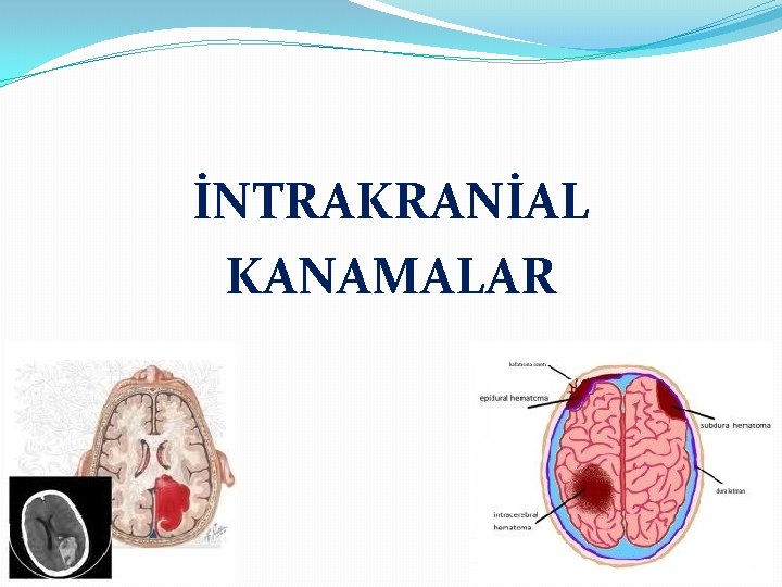 İNTRAKRANİAL KANAMALAR 