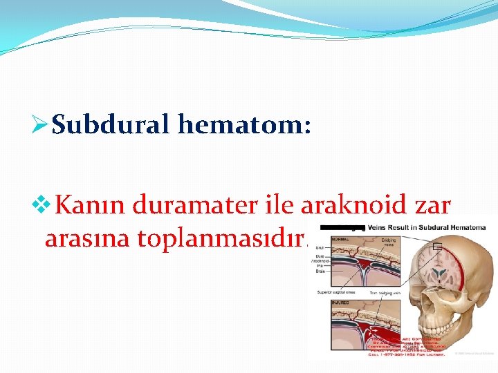 ØSubdural hematom: v. Kanın duramater ile araknoid zar arasına toplanmasıdır. 