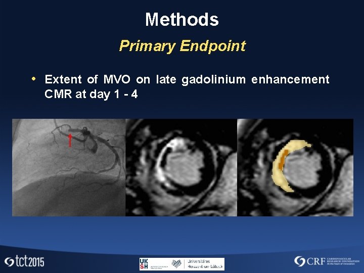 Methods Primary Endpoint • Extent of MVO on late gadolinium enhancement CMR at day