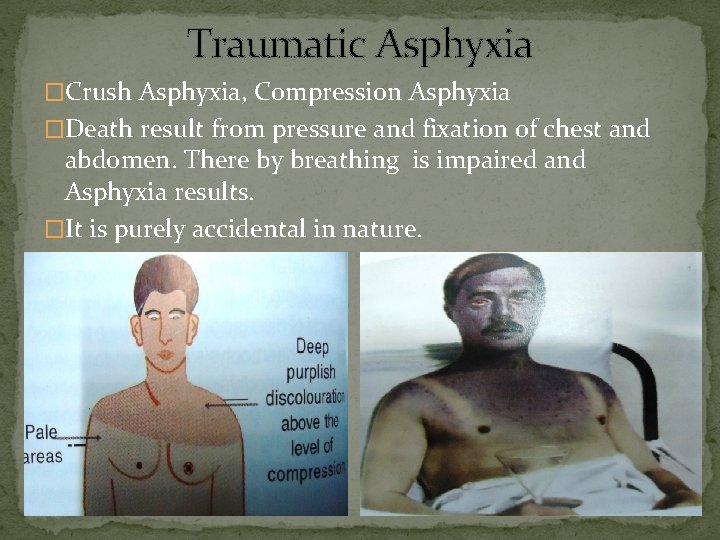 Traumatic Asphyxia �Crush Asphyxia, Compression Asphyxia �Death result from pressure and fixation of chest