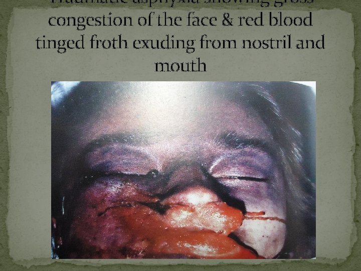 Traumatic asphyxia showing gross congestion of the face & red blood tinged froth exuding