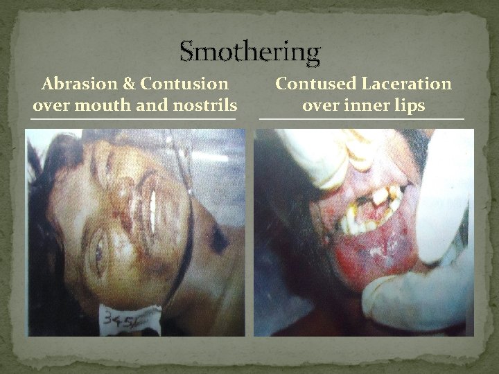 Smothering Abrasion & Contusion over mouth and nostrils Contused Laceration over inner lips 