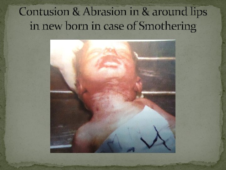 Contusion & Abrasion in & around lips in new born in case of Smothering