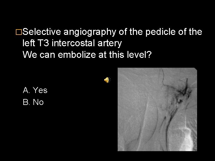 �Selective angiography of the pedicle of the left T 3 intercostal artery We can