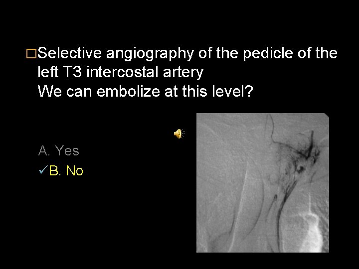 �Selective angiography of the pedicle of the left T 3 intercostal artery We can