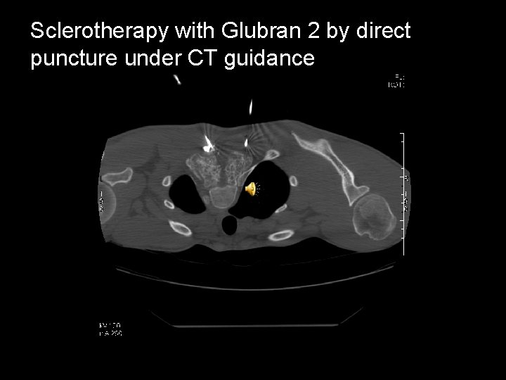 Sclerotherapy with Glubran 2 by direct puncture under CT guidance 