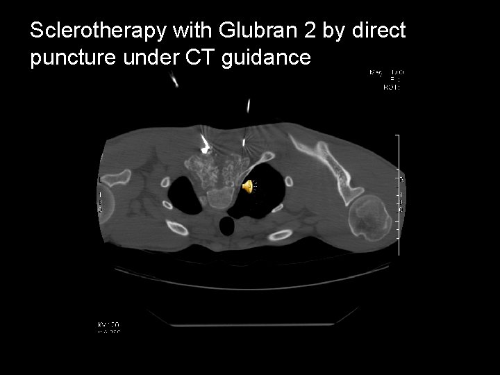 Sclerotherapy with Glubran 2 by direct puncture under CT guidance 