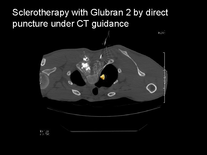 Sclerotherapy with Glubran 2 by direct puncture under CT guidance 