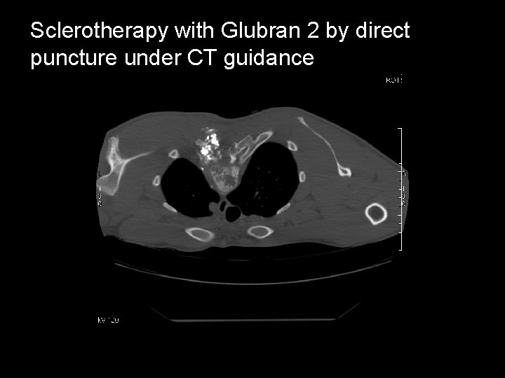 Sclerotherapy with Glubran 2 by direct puncture under CT guidance 