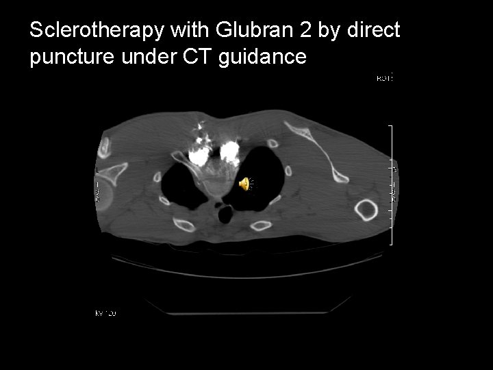 Sclerotherapy with Glubran 2 by direct puncture under CT guidance 