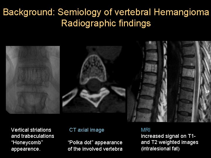 Background: Semiology of vertebral Hemangioma Radiographic findings Vertical striations and trabeculations “Honeycomb” appearence. CT