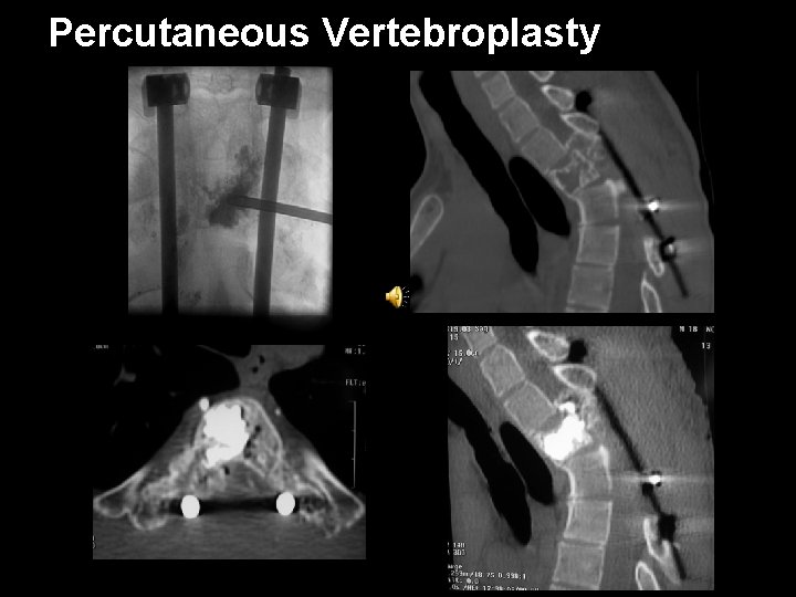 Percutaneous Vertebroplasty 