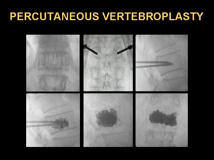 PERCUTANEOUS VERTEBROPLASTY 