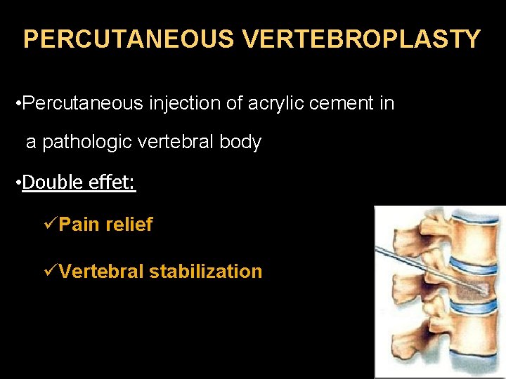 PERCUTANEOUS VERTEBROPLASTY • Percutaneous injection of acrylic cement in a pathologic vertebral body •