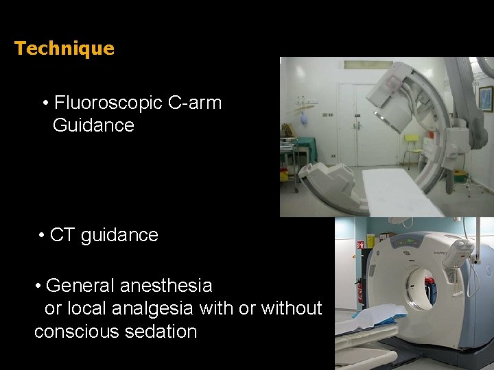 Technique • Fluoroscopic C-arm • Guidance • CT guidance • General anesthesia or local