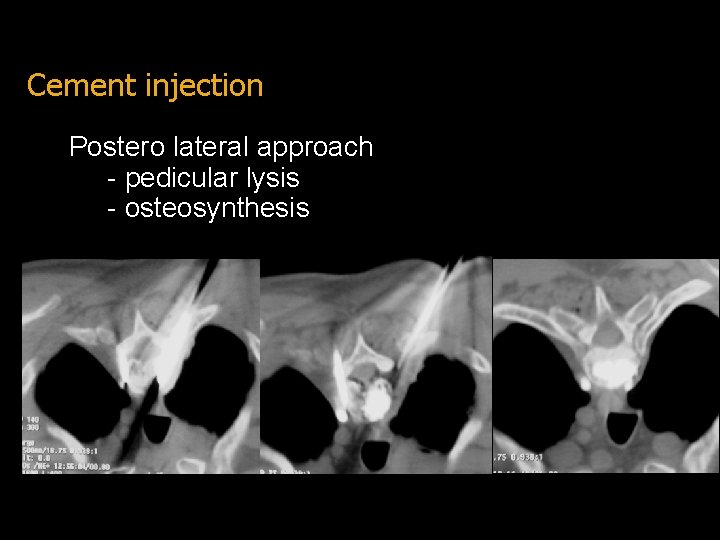 Cement injection Postero lateral approach - pedicular lysis - osteosynthesis 