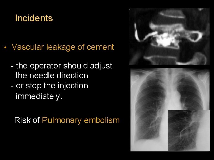Incidents • Vascular leakage of cement - the operator should adjust the needle direction