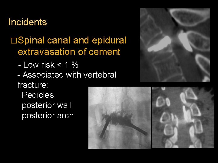 Incidents �Spinal canal and epidural extravasation of cement - Low risk < 1 %