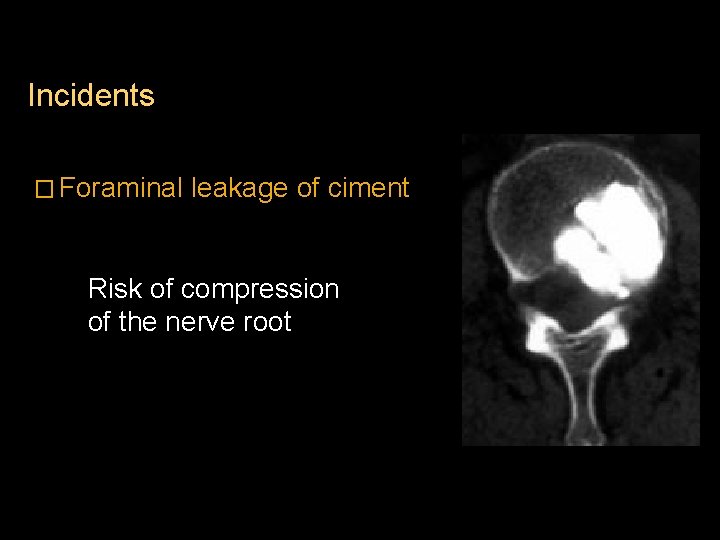 Incidents � Foraminal leakage of ciment Risk of compression of the nerve root 