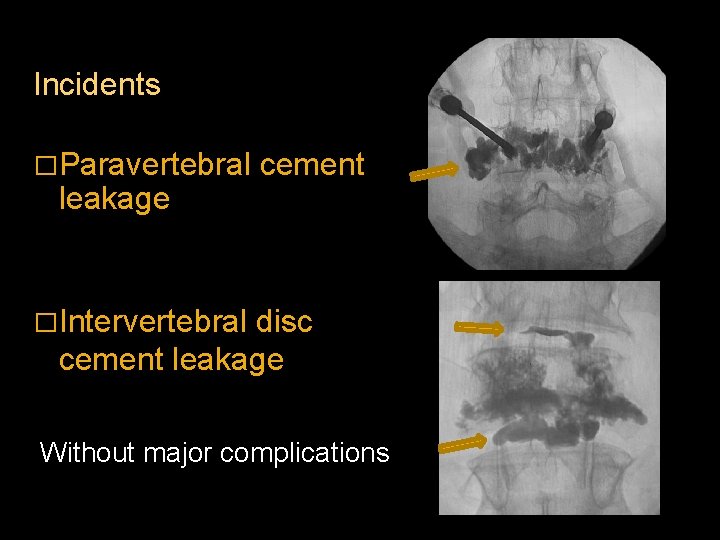 Incidents �Paravertebral leakage cement �Intervertebral disc cement leakage Without major complications 