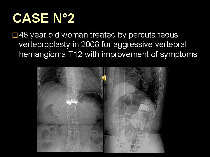 CASE N° 2 � 48 year old woman treated by percutaneous vertebroplasty in 2008