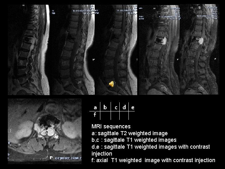 a f b c d e MRI sequences a: sagittale T 2 weighted image