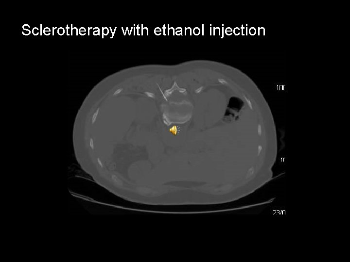 Sclerotherapy with ethanol injection 