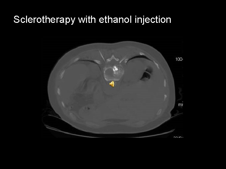 Sclerotherapy with ethanol injection 