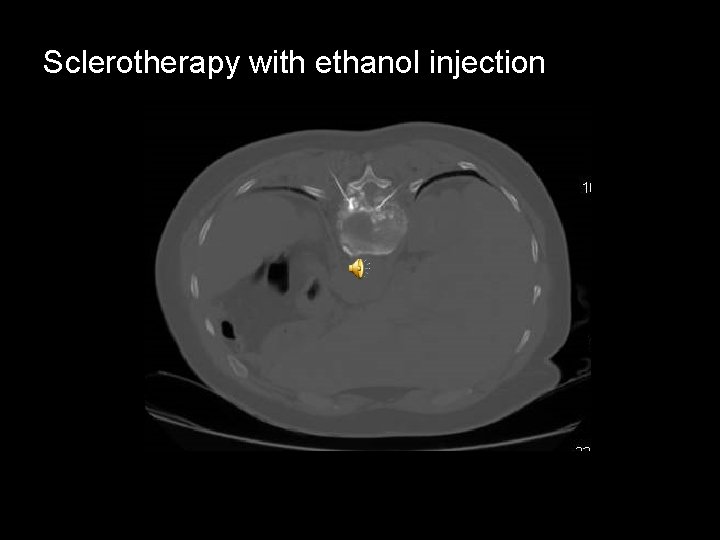 Sclerotherapy with ethanol injection 