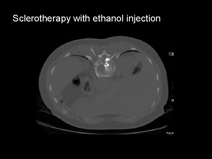 Sclerotherapy with ethanol injection 