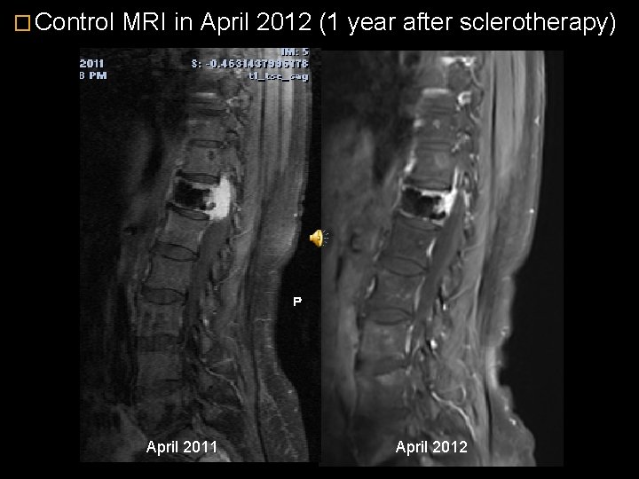 � Control MRI in April 2012 (1 year after sclerotherapy) April 2011 April 2012