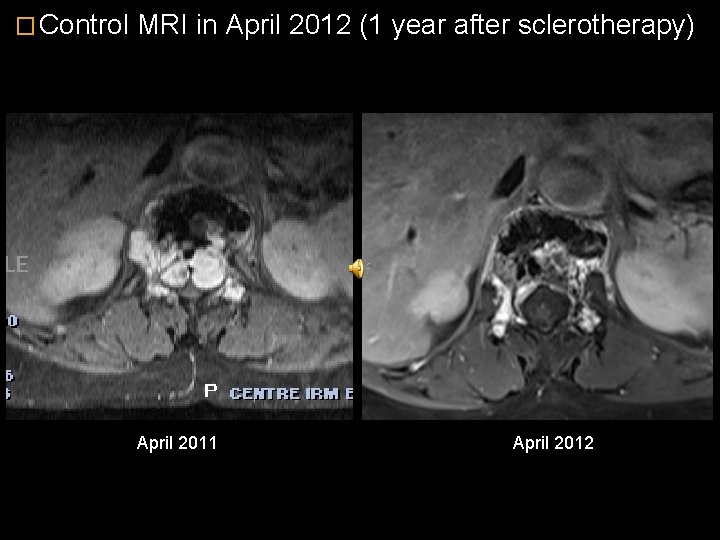 � Control MRI in April 2012 (1 year after sclerotherapy) April 2011 April 2012