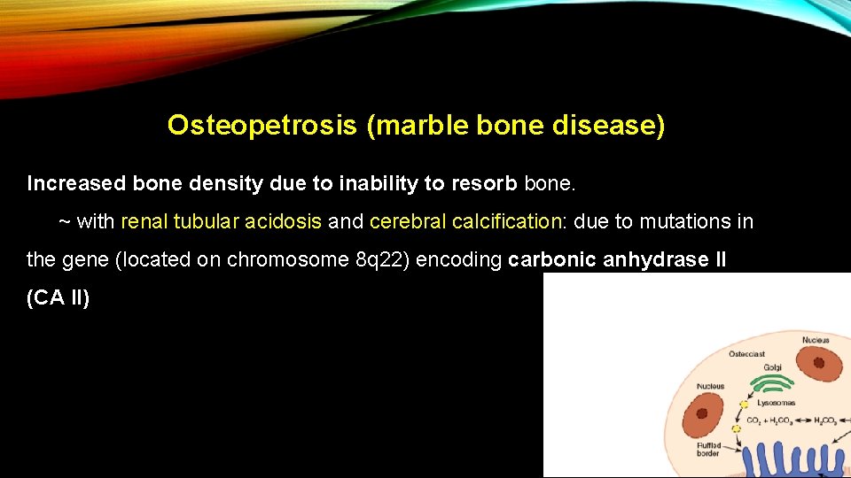 Osteopetrosis (marble bone disease) Increased bone density due to inability to resorb bone. ~