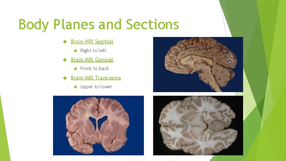 Body Planes and Sections Brain MRI Sagittal Brain MRI Coronal Right to left Front