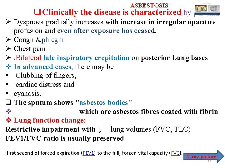 ASBESTOSIS q Clinically the disease is characterized by Ø Dyspnoea gradually increases with increase