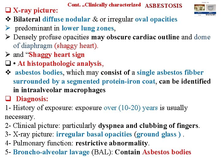 Cont. . . Clinically characterized ASBESTOSIS q X-ray picture: v Bilateral diffuse nodular &