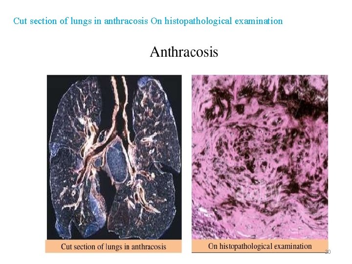 Cut section of lungs in anthracosis On histopathological examination 20 