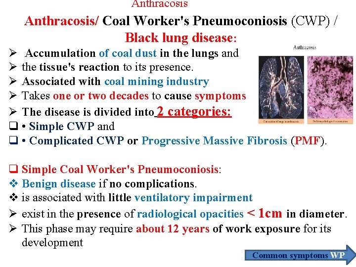 Anthracosis/ Coal Worker's Pneumoconiosis (CWP) / Black lung disease: Ø Accumulation of coal dust