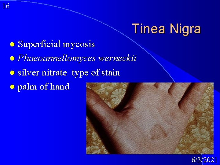 16 Tinea Nigra Superficial mycosis l Phaeoannellomyces werneckii l silver nitrate type of stain