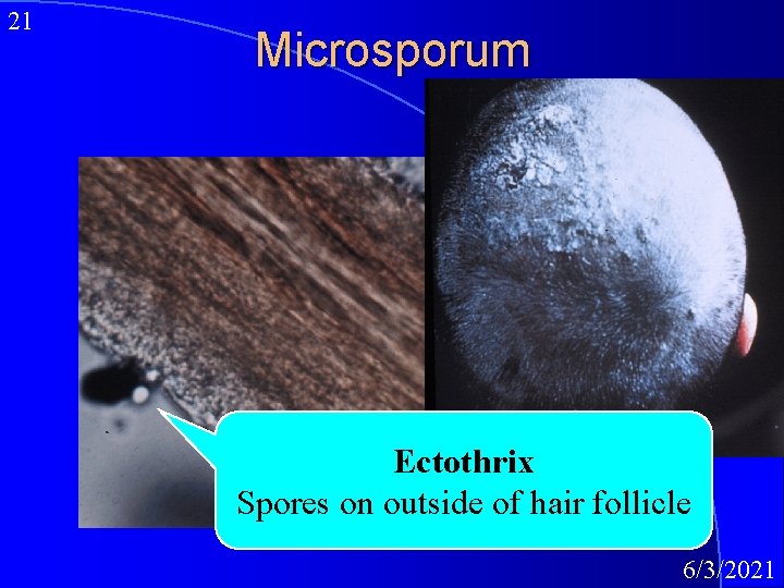 21 Microsporum Ectothrix Spores on outside of hair follicle 6/3/2021 