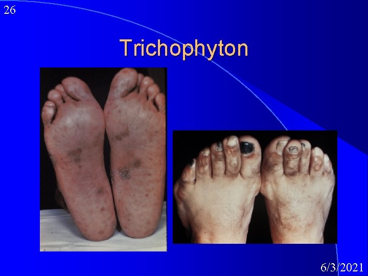26 Trichophyton 6/3/2021 